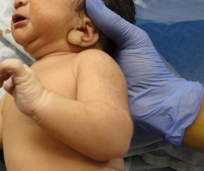 MHRA Vaccination shortage NHS